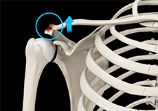 AC Joint Dislocation