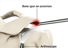 Arthroscopic Subacromial Decompression