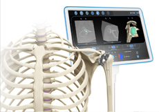 Computer Aided Joint Replacement