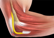 Olecranon Bursitis