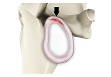 SLAP - Labral Tears